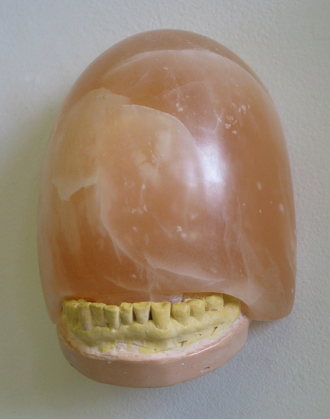Fred's Overbite